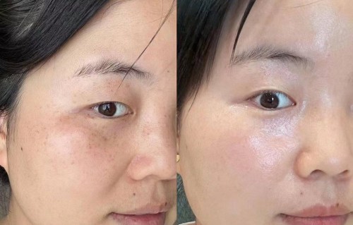 皮秒祛斑一次多少钱(皮秒祛斑10天变化图片)