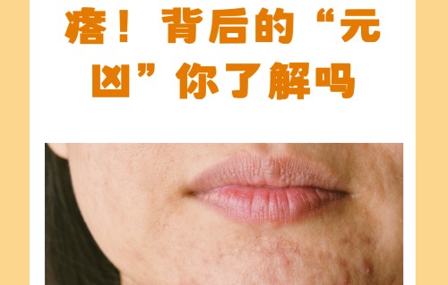 下巴长痘痘是什么原因(下巴长痘痘是什么原因主哪个脏腑)