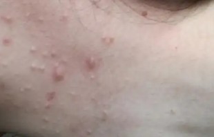 为什么脖子上会长痘痘(为什么脖子上会长痘痘不痛不痒)