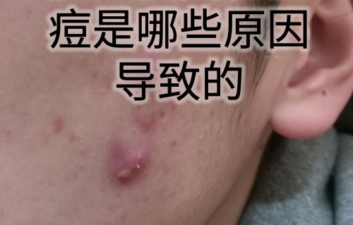 怀孕脸上长痘痘是什么原因(怀孕脸上长痘痘是什么原因是怀男孩吗)