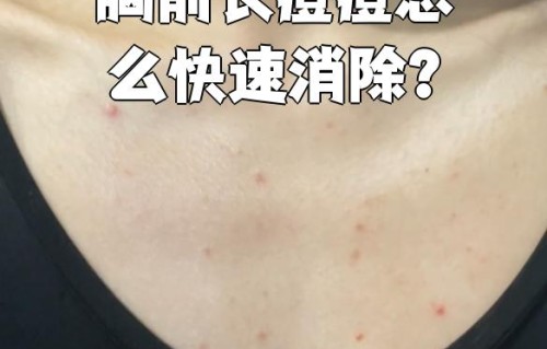 胸上长痘痘怎么回事(乳房上长了脓包型痘痘)