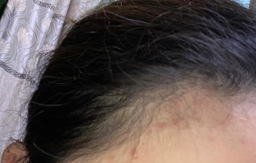 发际线长痘痘是什么原因(额头和发际线长痘痘是什么原因)