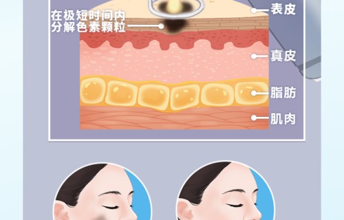 皮秒激光祛斑的弊端(皮秒祛斑的费用一般是多少)